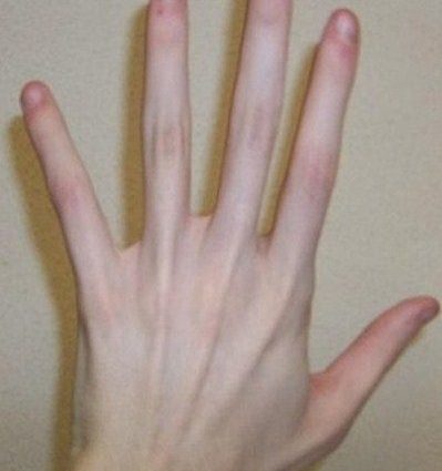 Marfan syndrome (arachnodactyly, finger spider veins)