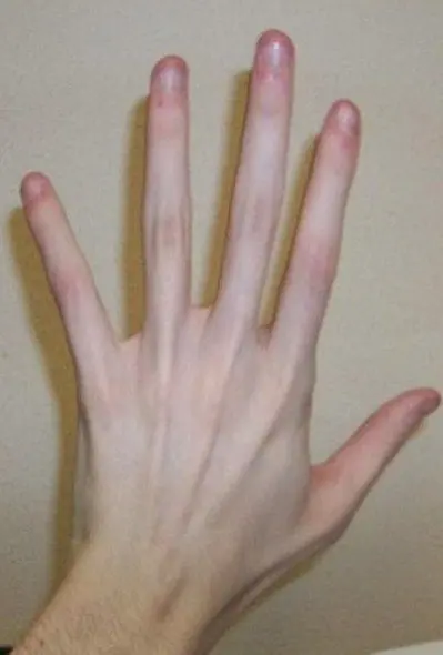 Marfan syndrome (arachnodactyly, finger spider veins)