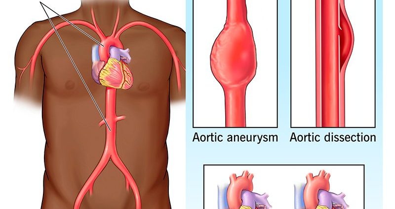 Zespół Marfana Przyczyny Objawy Diagnostyka I Leczenie Zdrowa żywność W Pobliżu 1240