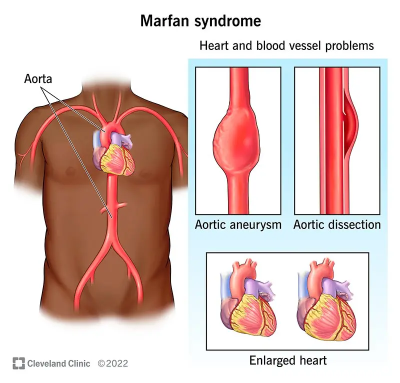 Marfan&#8217;s syndrome &#8211; causes, symptoms, diagnosis and treatment