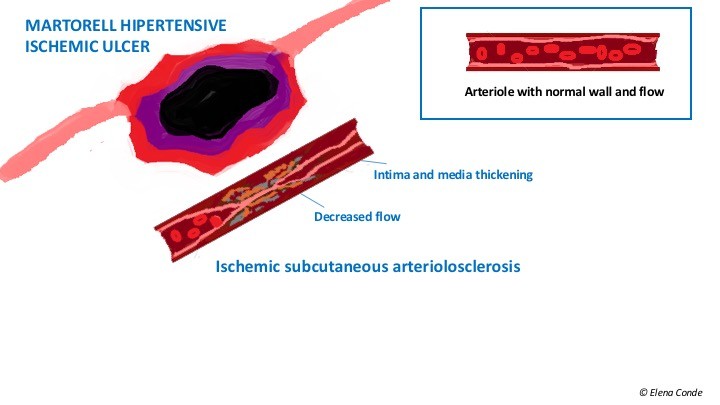 Martorelli ulcer &#8211; symptoms and treatment