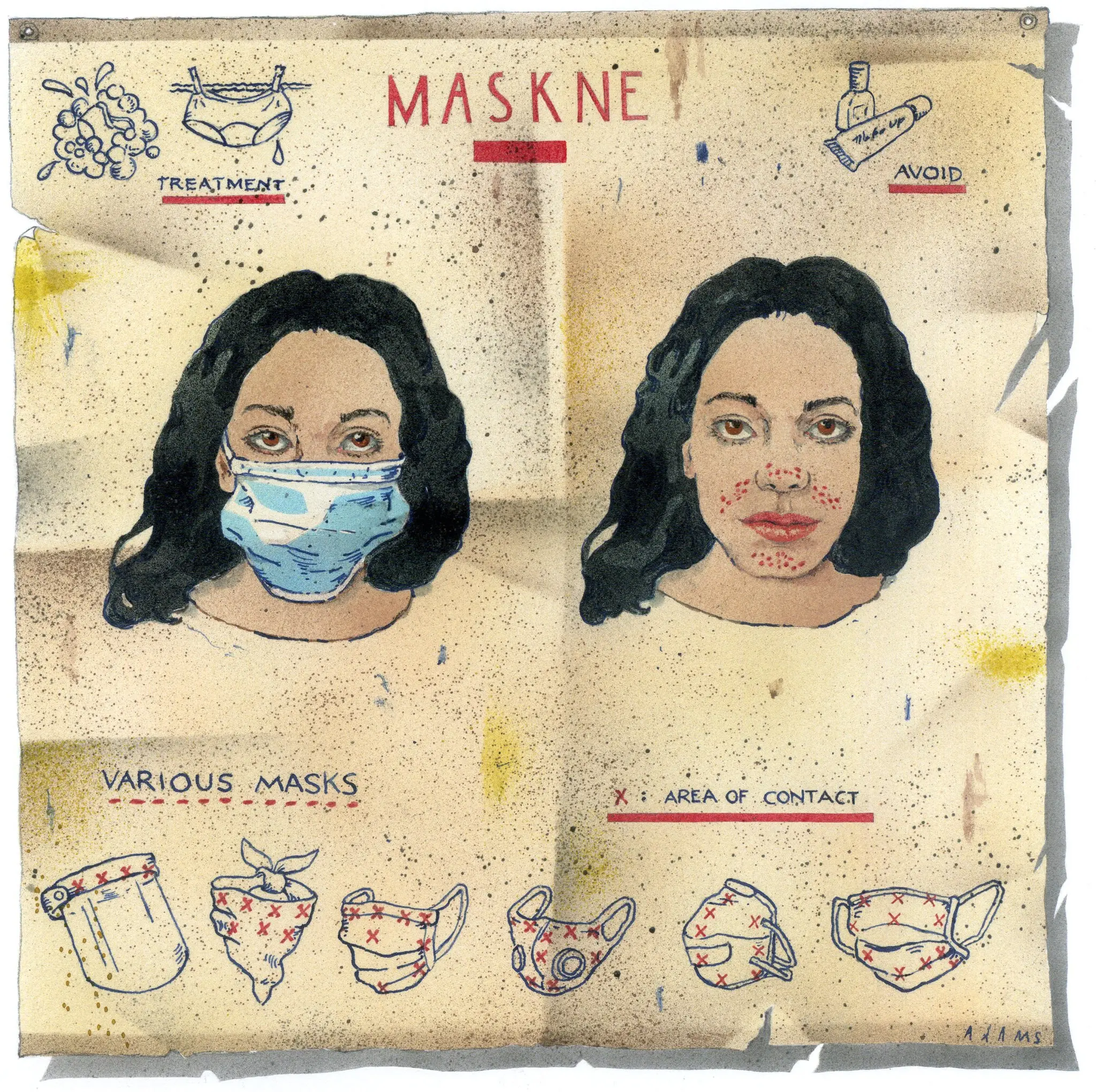 Maskne, a souvenir of a mask in the form of acne. How can I get rid of it?