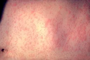 Measles &#8211; a rash viral disease