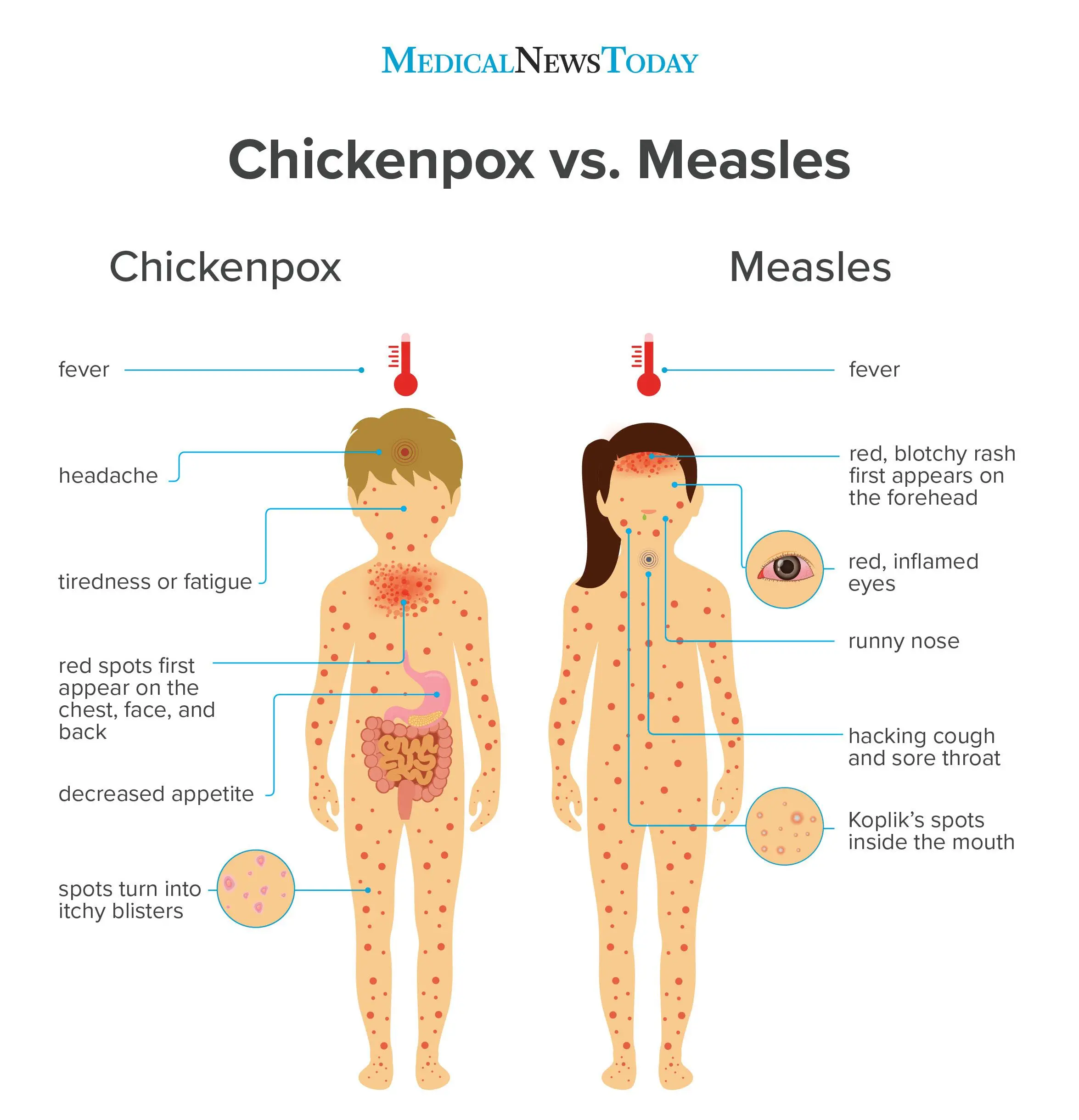 Measles is not a mild childhood disease