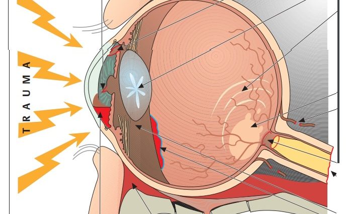 Mechanical injuries of the eye and orbit &#8211; types of injuries, eye wounds