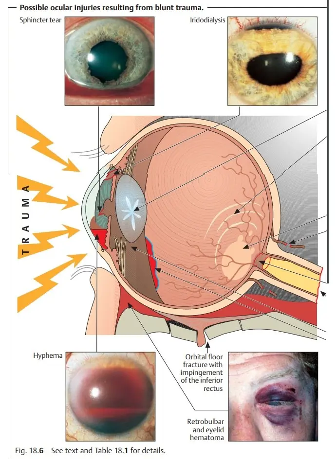 Mechanical injuries of the eye and orbit &#8211; types of injuries, eye wounds