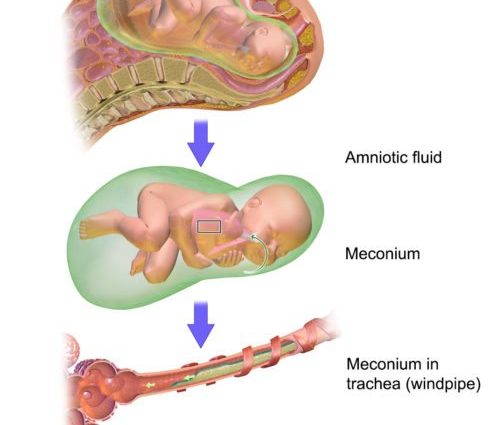 Meconium in a newborn &#8211; what is it? By when should she be expelled?