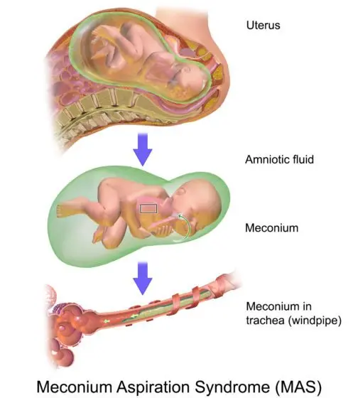 Meconium in a newborn &#8211; what is it? By when should she be expelled?