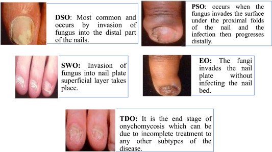 Medicines for onychomycosis &#8211; how to choose the best? [WE EXPLAIN]