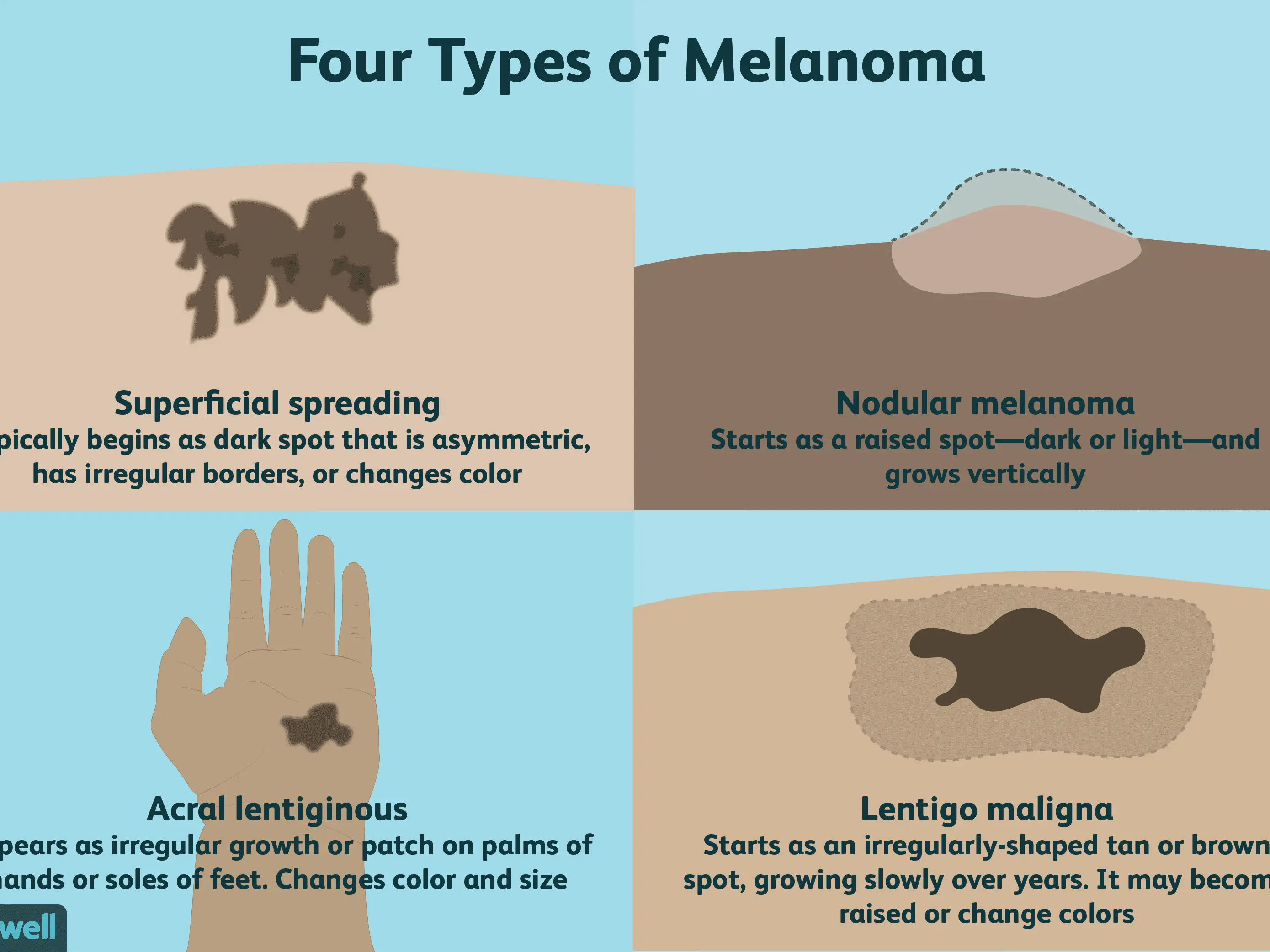 Melanoma &#8211; everything you need to know about it &#8230;