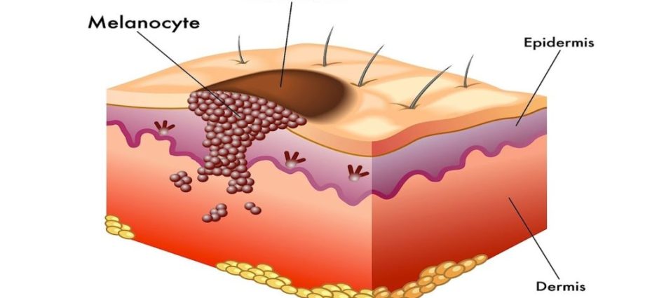 Melanoma &#8211; how is it formed?