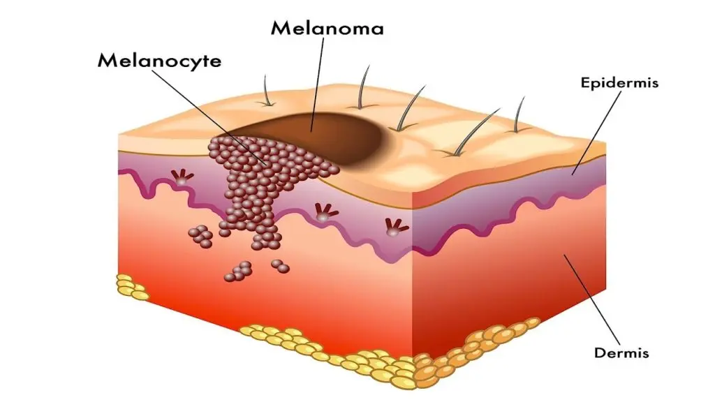 Melanoma &#8211; how is it formed?