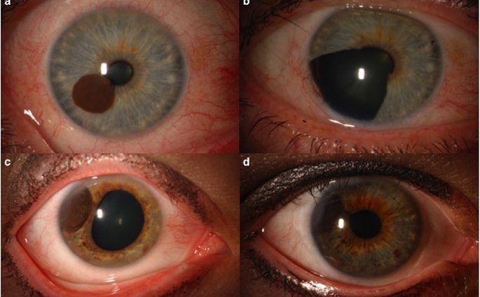 Melanoma is not just skin cancer. The 59-year-old was diagnosed with this cancer in the eyeball