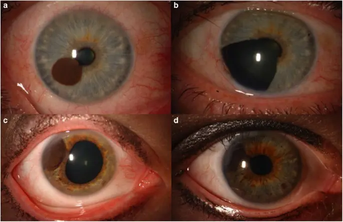 Melanoma is not just skin cancer. The 59-year-old was diagnosed with this cancer in the eyeball