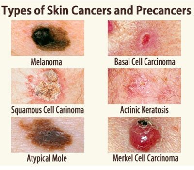 Melanoma &#8211; starts with an innocent mole