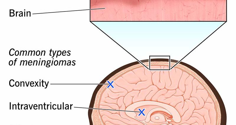 Meningioma &#8211; symptoms, prognosis