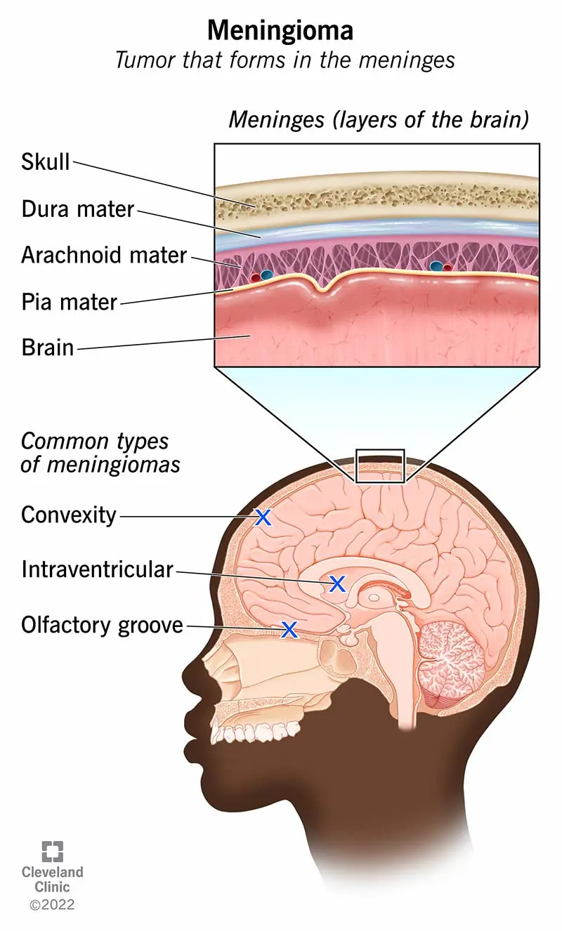 Meningioma &#8211; symptoms, prognosis