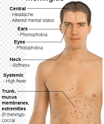 Meningococcal meningitis