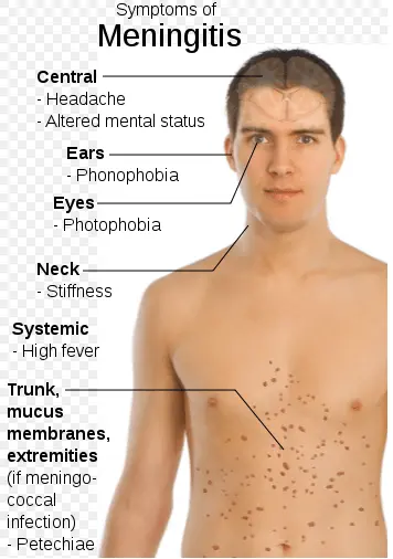 Meningococcal meningitis