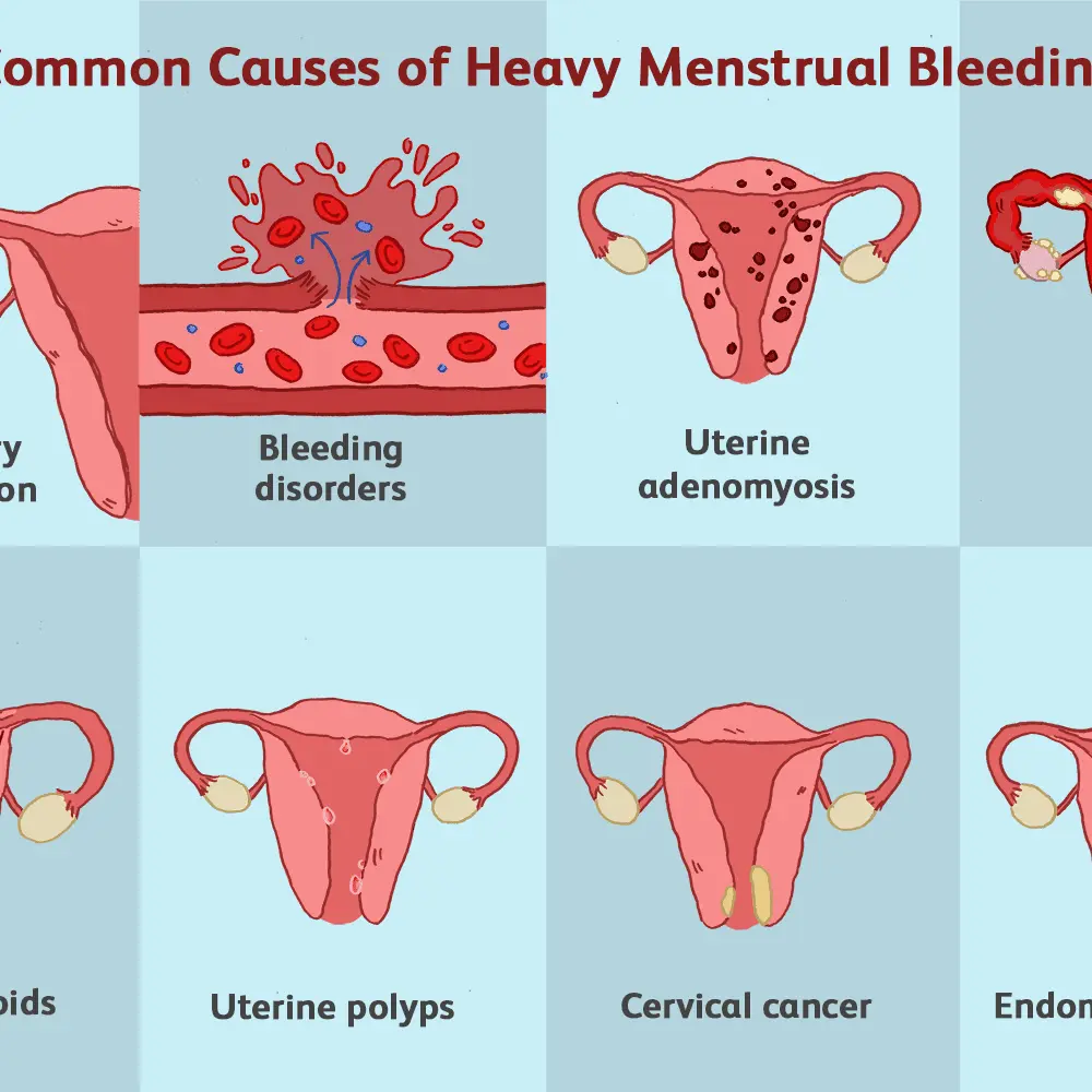 Menstrual bleeding