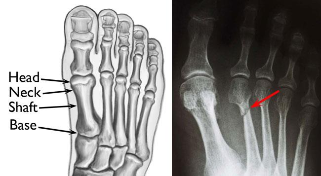 Metatarsal and toe fractures &#8211; what is the treatment?