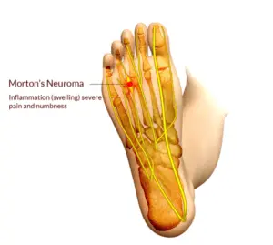 Metatarsalgia Morton (Morton&#8217;s neuroma) &#8211; causes, symptoms, diagnosis