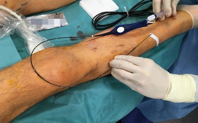 Methods of removing varicose veins of the lower extremities &#8211; non-invasive, surgical, chemical-mechanical