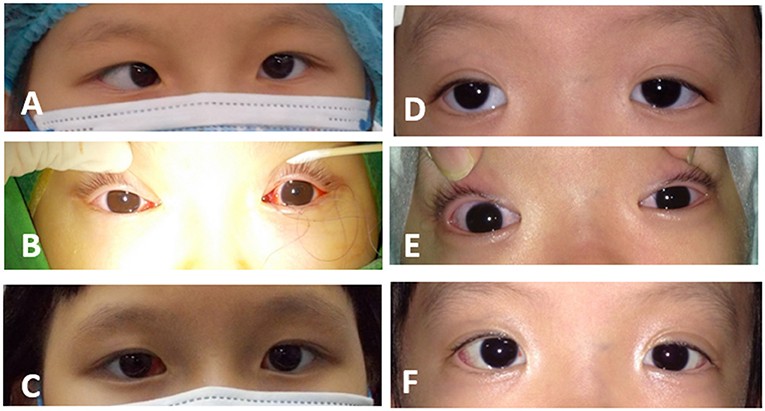 Methods of treating strabismus in children