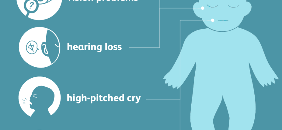 Microcephaly &#8211; characteristics, causes and symptoms of microcephaly