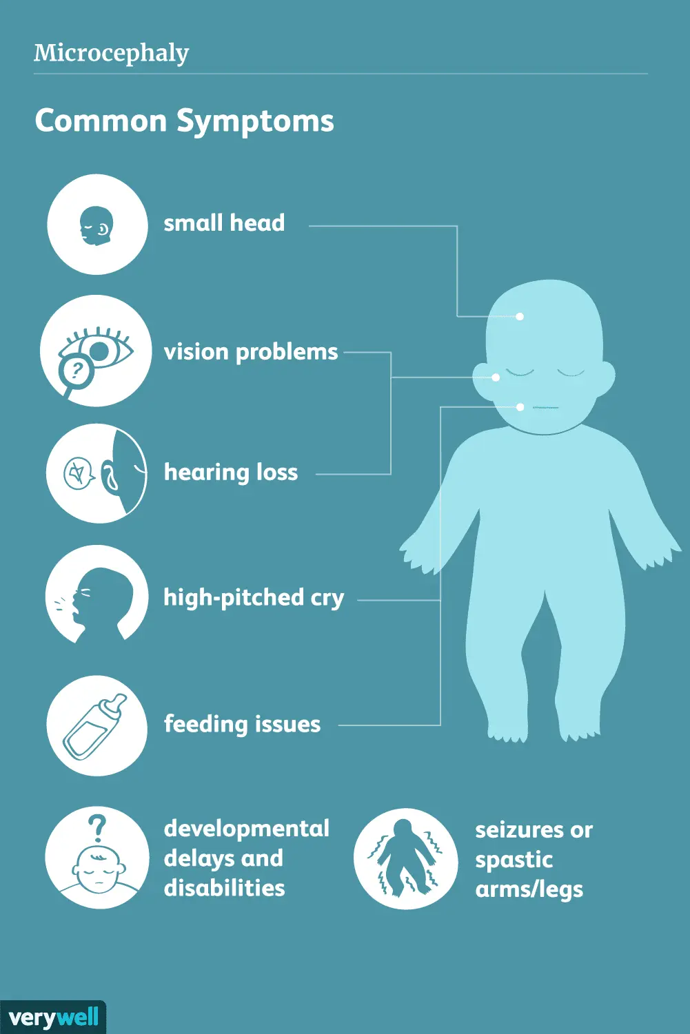 Microcephaly &#8211; characteristics, causes and symptoms of microcephaly