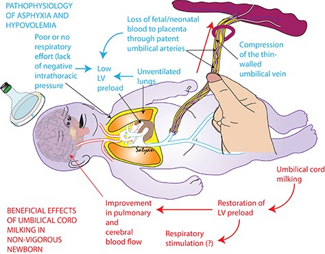 Milking the umbilical cord helps premature babies