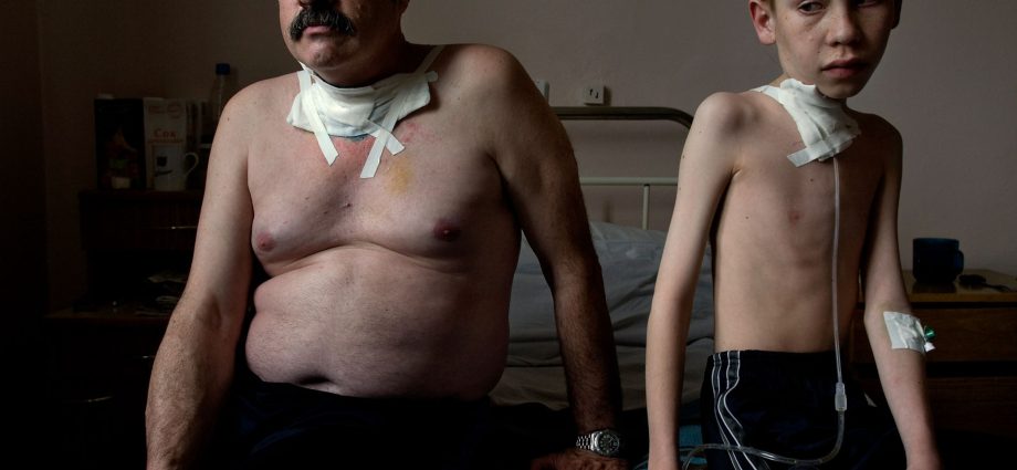 Missing limbs and twisted joints. This is how the «children of Chernobyl» live today