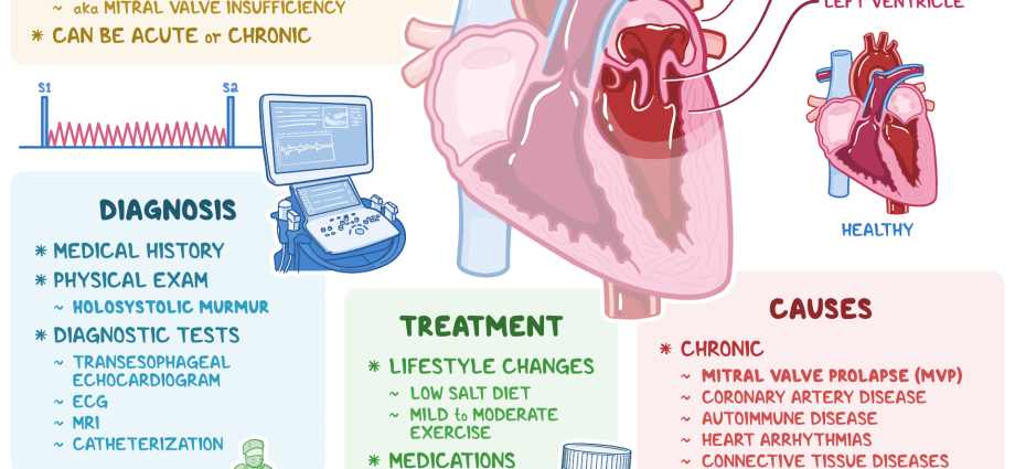 Mitral valve insufficiency &#8211; causes, symptoms, treatment