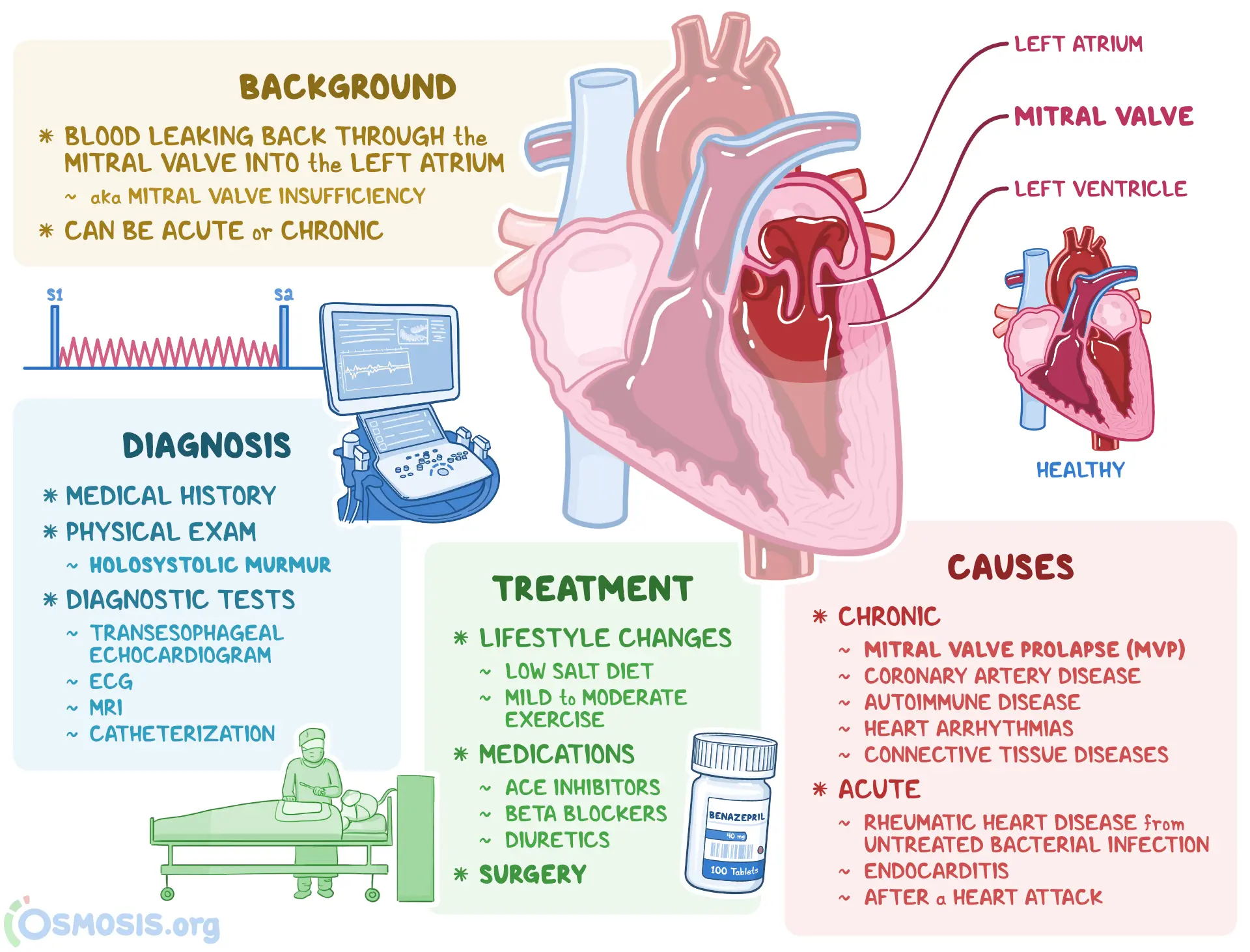 Mitral valve insufficiency &#8211; causes, symptoms, treatment