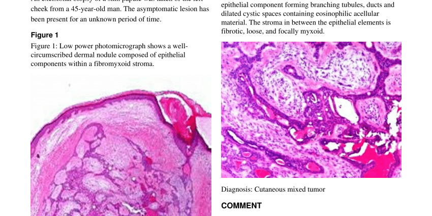 Mixed skin tumor &#8211; who it affects, location, treatment