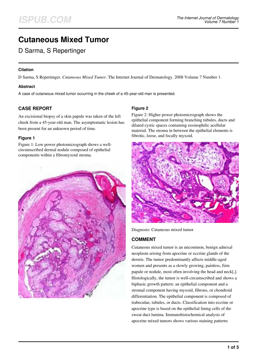 Mixed skin tumor &#8211; who it affects, location, treatment