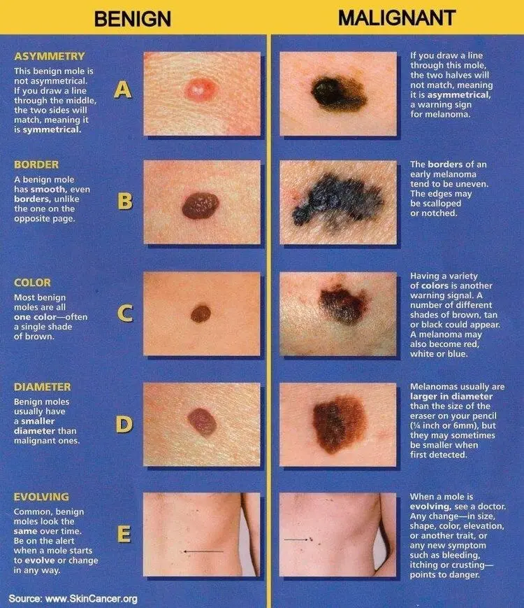 Moles and benign tumors