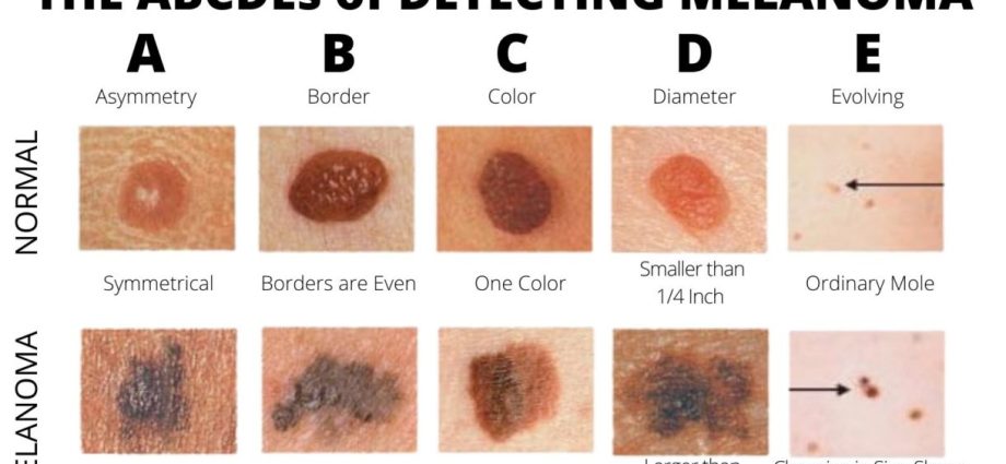 Moles &#8211; types, formation, removal. Moles and the risk of cancer