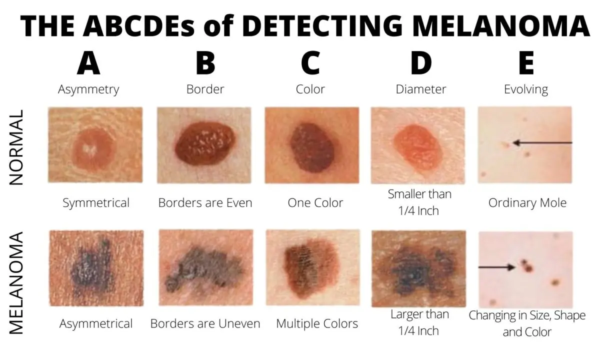 Moles &#8211; types, formation, removal. Moles and the risk of cancer