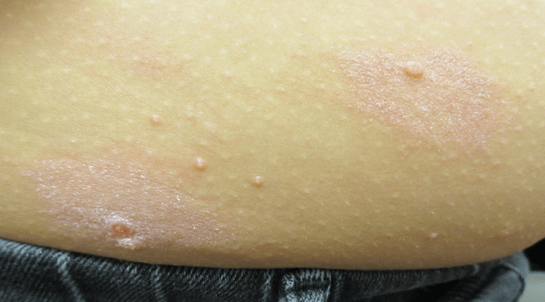 Mollusk eczema