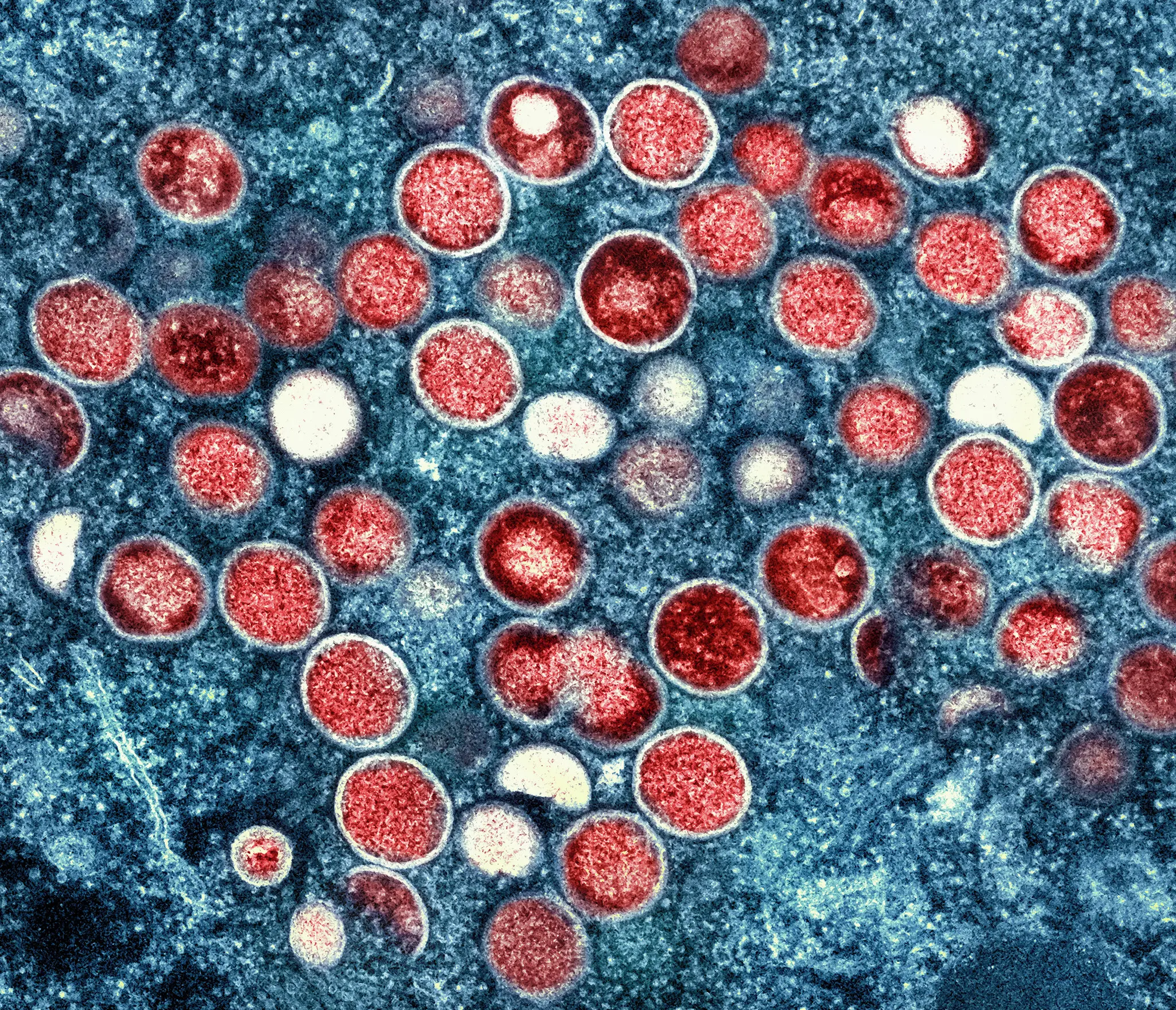 Monkey pox and COVID-19 may meet in the fall. Minister Niedzielski explains what this means