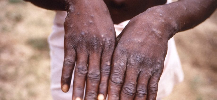 Monkey pox can be the &#8220;real threat&#8221;. WHO warns