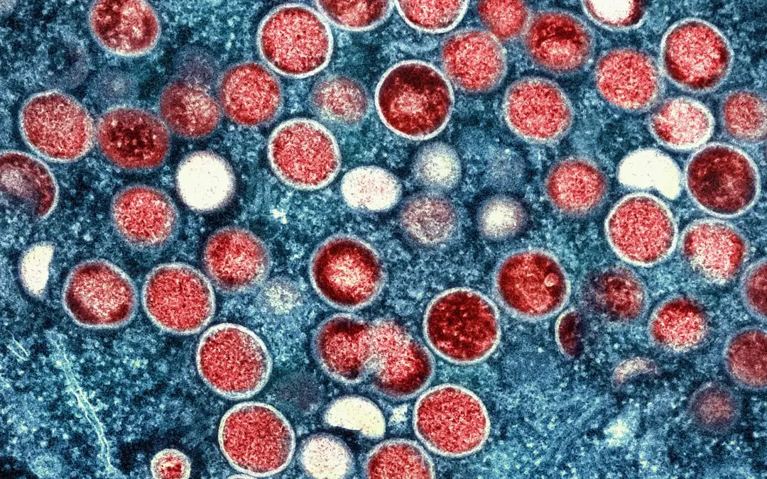 Monkey pox is already in Poland. What do we know about the disease?