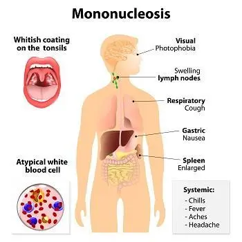 Mononucleosis in children &#8211; symptoms, treatment