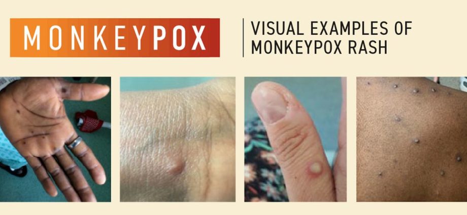 More and more cases of monkey pox. Urgent WHO meeting