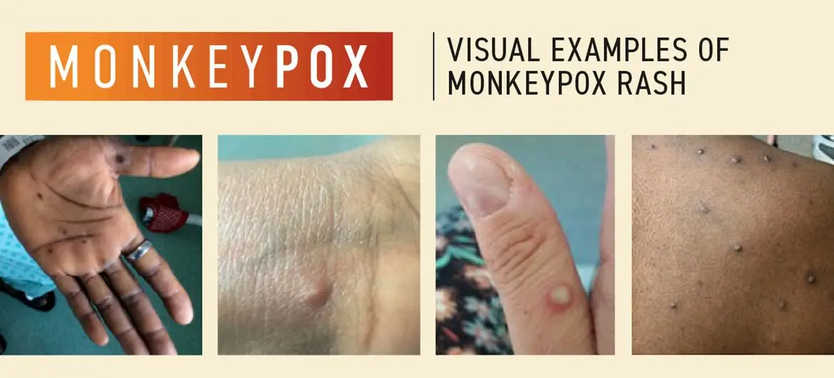 More and more cases of monkey pox. Urgent WHO meeting