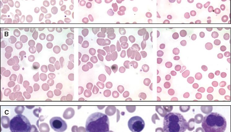 Morphology with manual smear &#8211; a study that saves lives