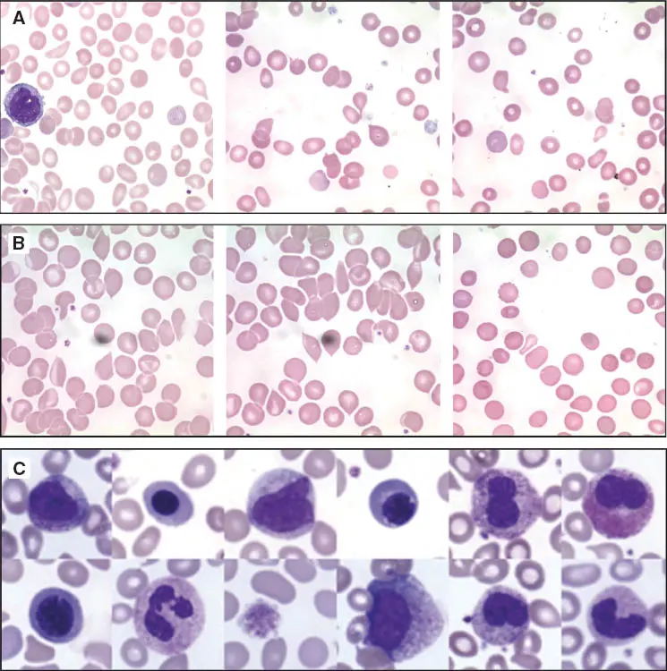 Morphology with manual smear &#8211; a study that saves lives