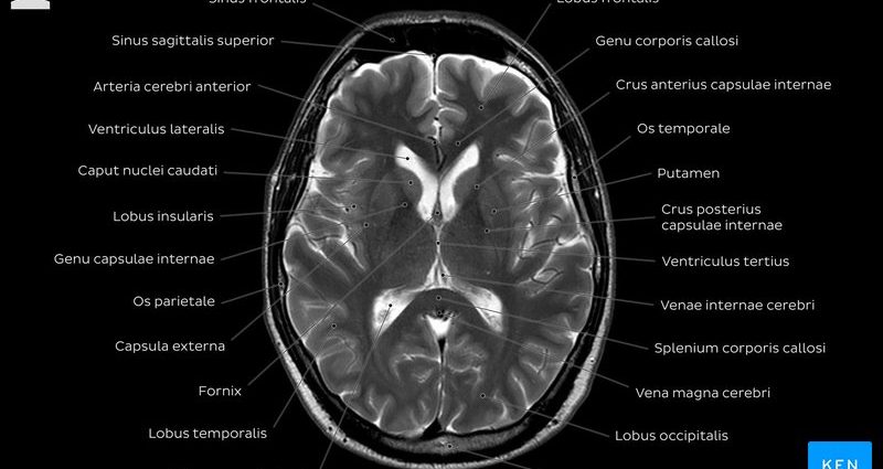 MRI of the head &#8211; how to interpret the results?