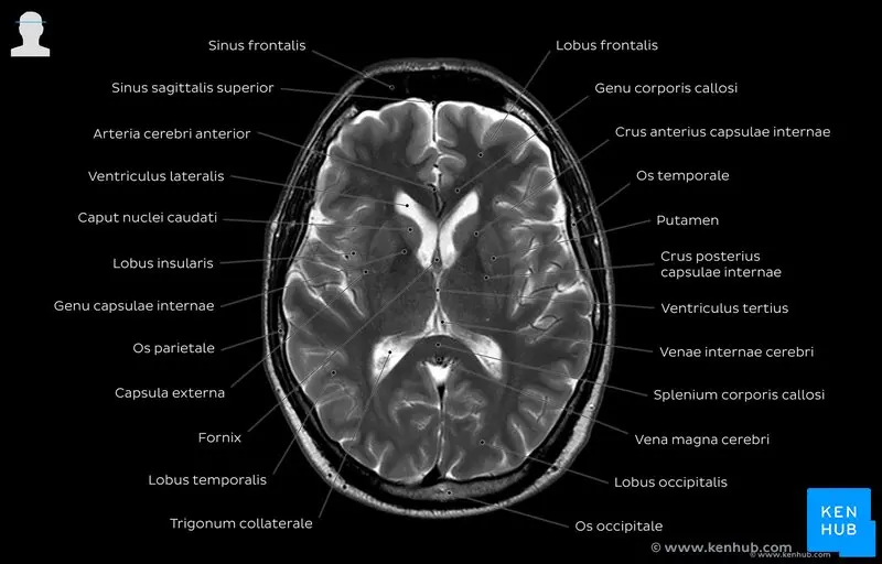 MRI of the head &#8211; how to interpret the results?